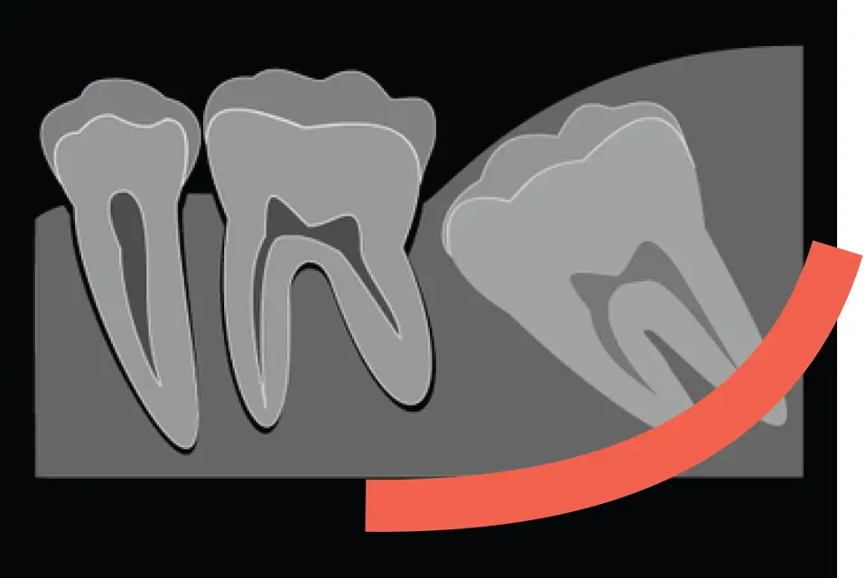 親知らずの抜歯